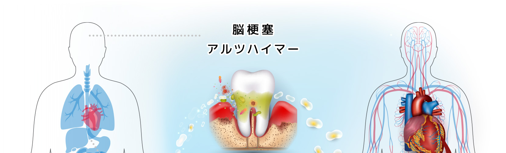 歯周病や口の中の細菌にまつわる病気