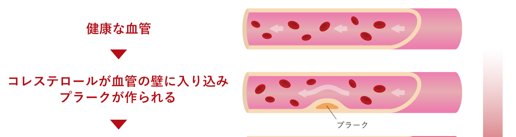 糖尿病になると動脈硬化が起こりやすい