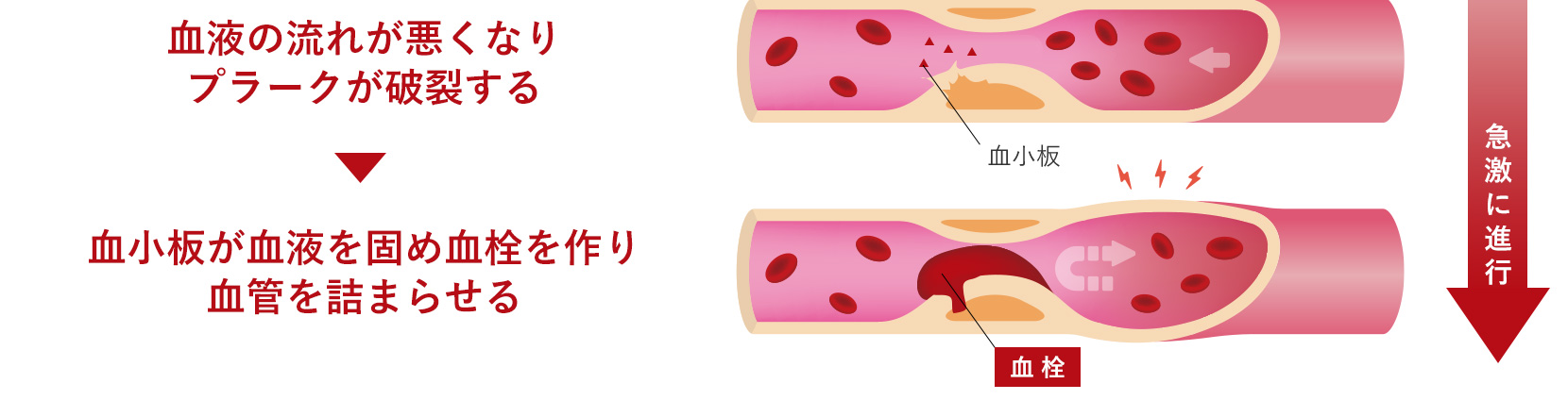 糖尿病になると動脈硬化が起こりやすい