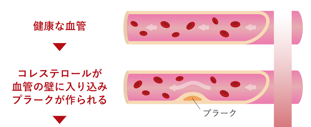 糖尿病になると動脈硬化が起こりやすい