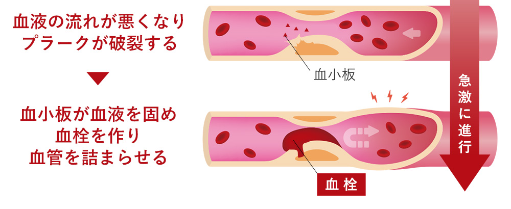 糖尿病になると動脈硬化が起こりやすい