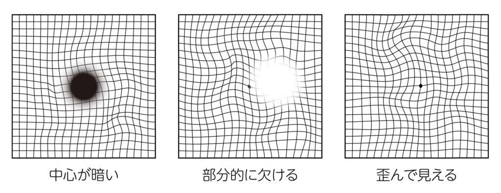 アムスラーグリッド