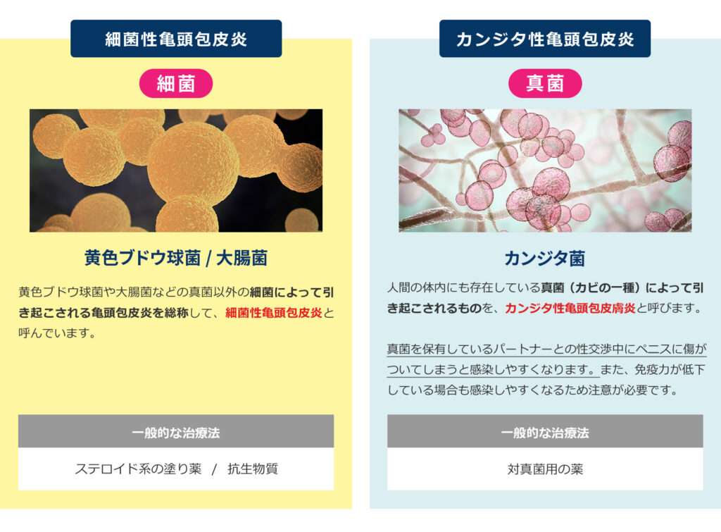 細菌性亀頭包皮炎とカンジタ性亀頭包皮炎